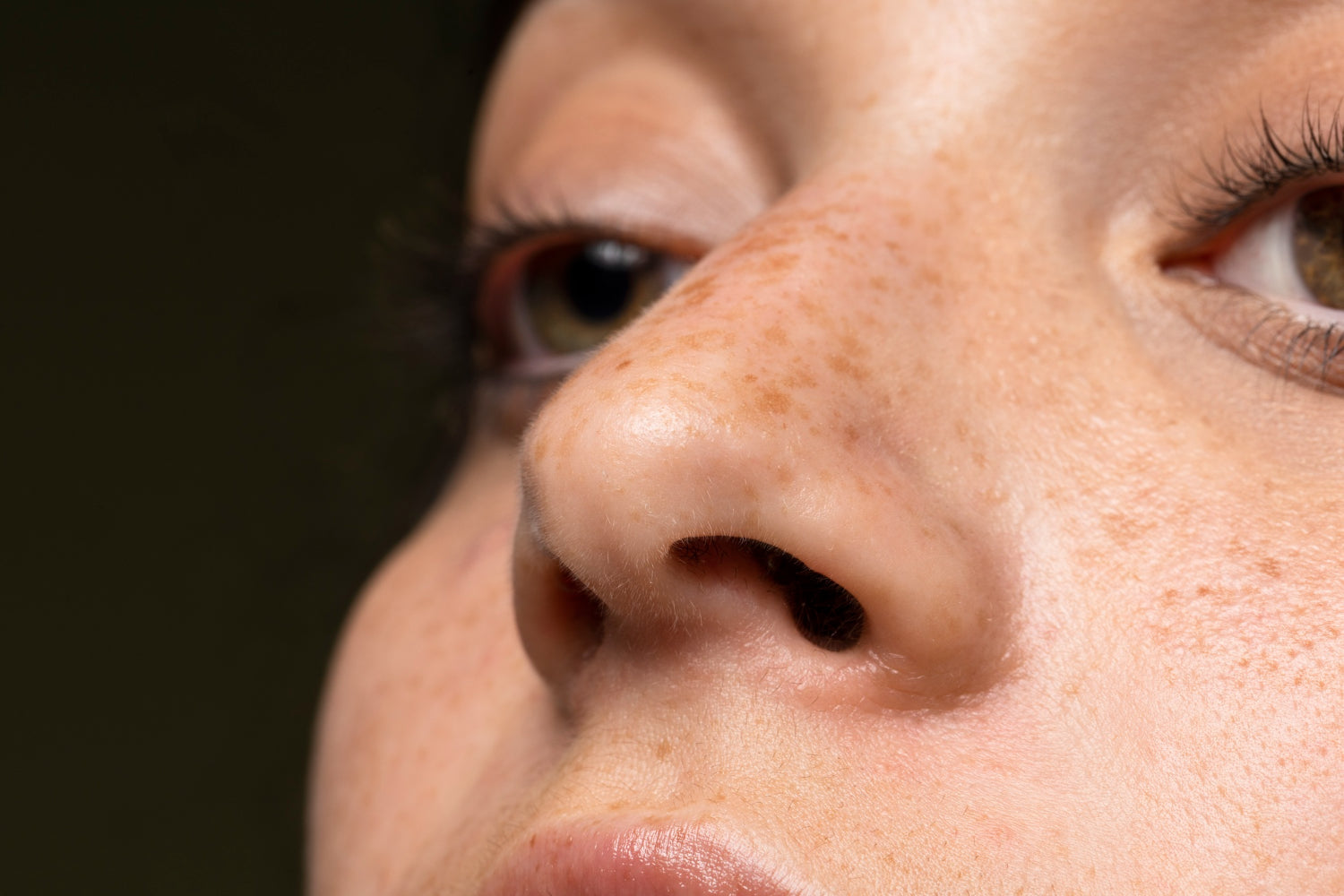 The Ultimate "Inside-Out" Routine for Fading 10-Year-Old Melasma