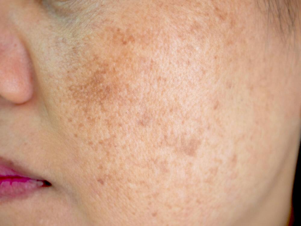 The Hidden Triggers Making Your Melasma Worse