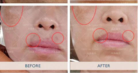 Understanding Pigmentation And Melasma